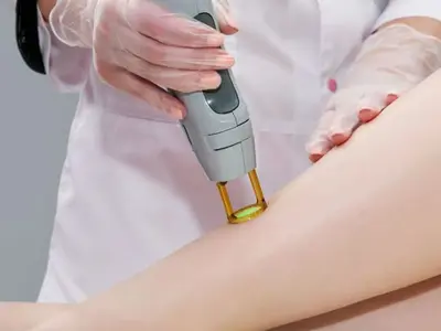 Laser hair removal
