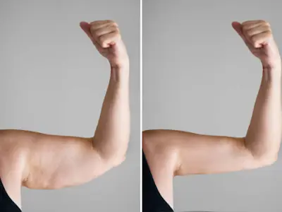 Liposuction Treatment