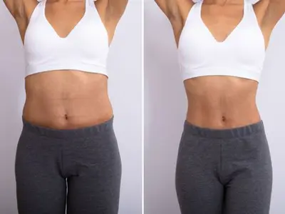 Liposuction