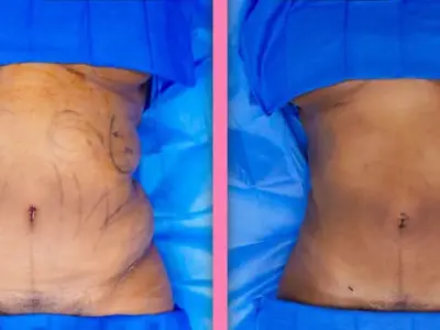 Lipo 360