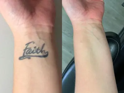 Tattoo removal