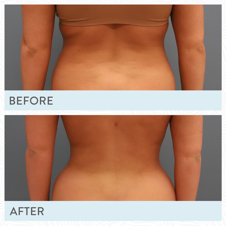 Lipo 360: Full-Body Contouring That Targets All the Righ