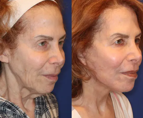 image for post Letybo Results: Real Before and After Stories from Our Medical Cosmetic Practice