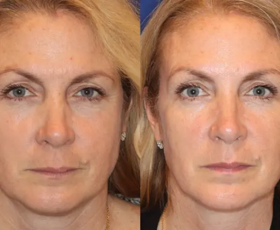 image for post Maximizing Your Letybo Experience: Expert Tips for Optimal Anti-Aging Results