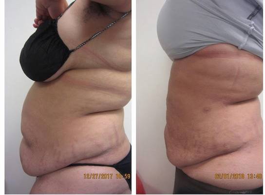 Renuvion/J-Plasma Body Contouring