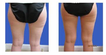 Saddlebag/outer thigh coolscullpting Dr Varano Washington DC Saddlebag/outer thigh coolscullpting Dr Varano Washington DC
