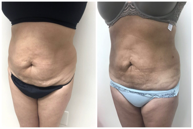 Renuvion/ J plasma treatment by Dr Varano Renuvion/ J plasma treatment by Dr Varano