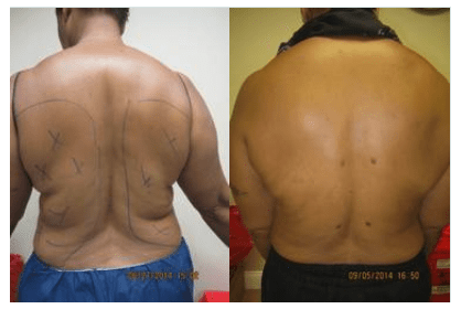 Upper & Lower Back liposuction Drew Varano MD Washington DC