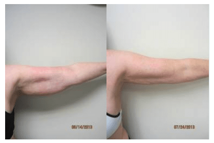 Laser Liposuction 600 Coolsculpting Wash Dc Liposuction Laser Lipo