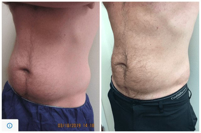 Coolsculpting before /after Drew Varano