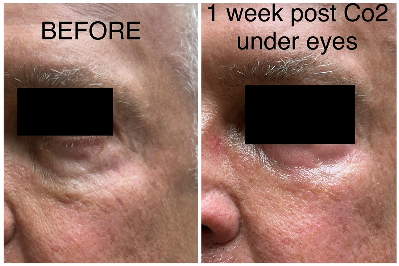 co2 laser