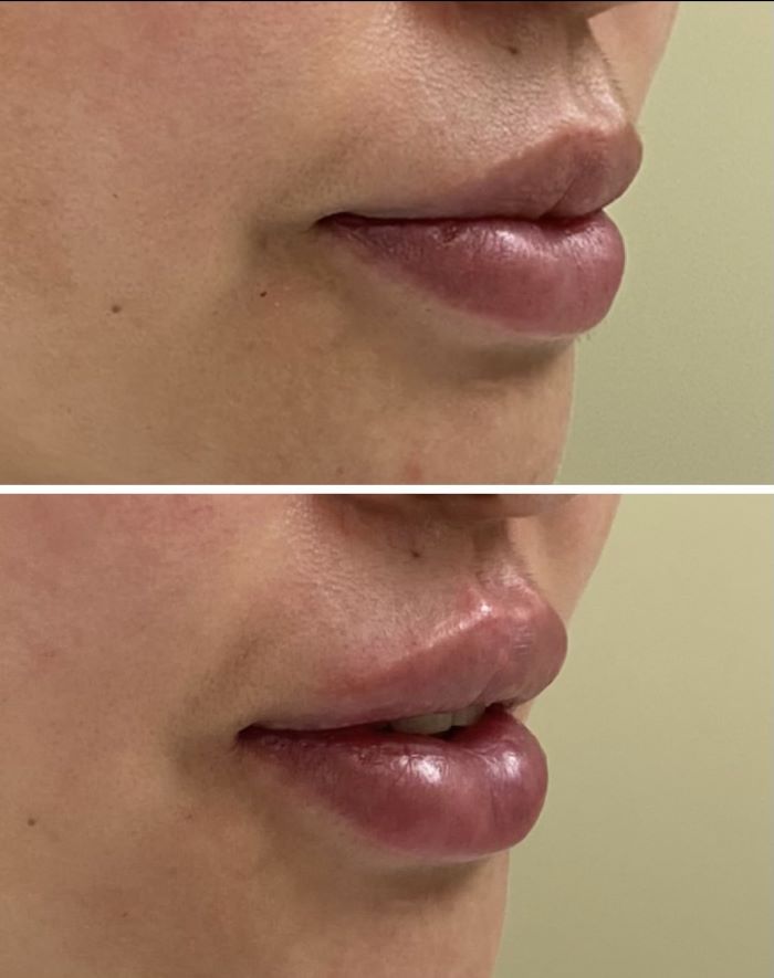 Lip filler before and After