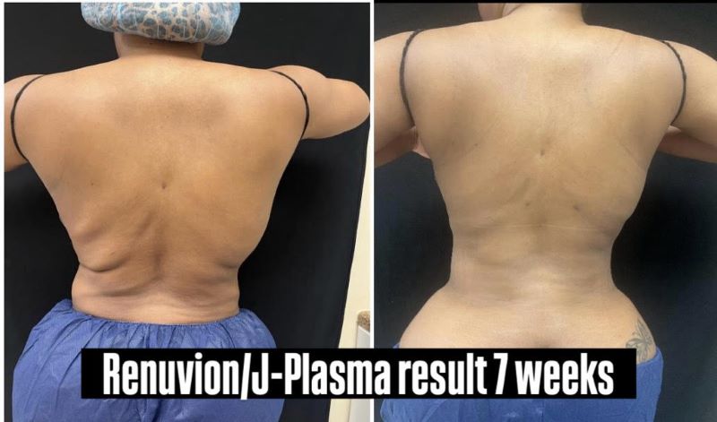 Renuvion and Back Liposucion