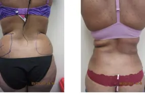 Before and after of lovhandle liposuction by Dr. Drew Varano in Washington DC