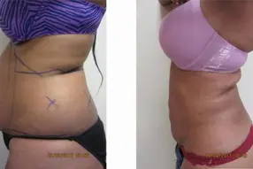 Before and after of abdomen liposuction by Dr. Drew Varano in Washington DC