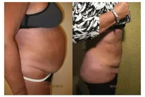 Before and after 1 week abdomen liposuction by Dr. Drew Varano in Washington DC