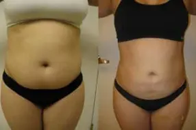Before and after of abdomen liposuction by Dr. Drew Varano in Washington DC