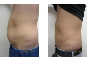 Before and after  Liposuction Male by Medical Cosmetic Enhancementsin Washington DC