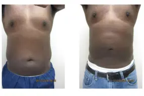 Before and after  Liposuction Male by Medical Cosmetic Enhancements Dr Varano in Washington DC
