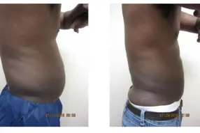 Before and after  Liposuction Male by Medical Cosmetic Enhancements Dr Varano in Washington DC