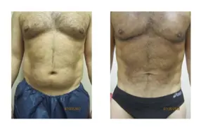 Before and after  Liposuction Male by Medical Cosmetic Enhancements Dr Varano in Washington DC