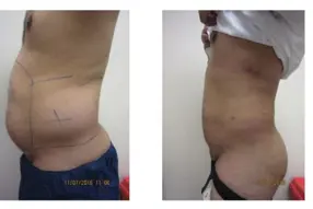 Before and after  Liposuction Male by Medical Cosmetic Enhancements Dr Varano in Washington DC