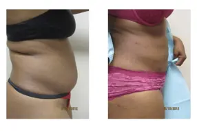 Before and after of abdomen liposuction by Dr. Drew Varano in Washington DC