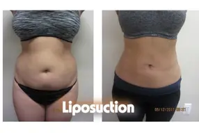 Before and after of abdomen liposuction by Dr. Drew Varano in Washington DC