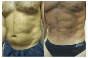 Before and after  Liposuction Male by Medical Cosmetic Enhancements Dr Varano in Washington DC