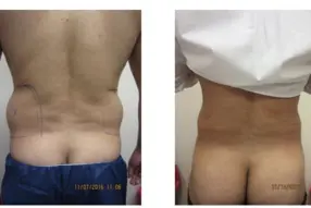 Before and after Liposuction Male lovehandles by Medical Cosmetic Enhancements Dr Varano in Washington DC
