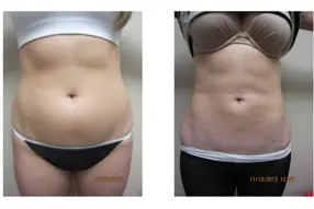 Before and after of abdomen liposuction by Dr. Drew Varano in Washington DC