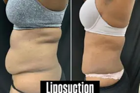 Before and after of liposuction 360 by Dr. Drew Varano in Washington DC