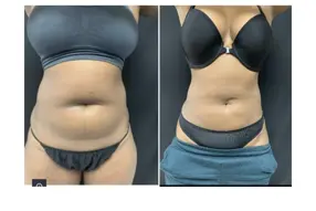 Before and after of abdomen liposuction by Dr. Drew Varano in Washington DC