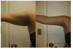 Before and after of arm liposuction by Dr. Drew Varano in Washington DC