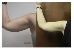Before and after of arm liposuction at 1 week by Dr. Drew Varano in Washington DC