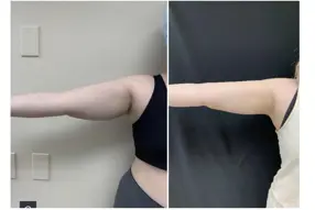 Before and after arm liposuction by Dr. Drew Varano in Washington DC