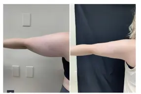 Before and after arm liposuction by Dr.Drew Varano in Washington DC