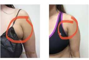 Before and after bra fat liposuction by Dr.Drew Varano in Washington DC