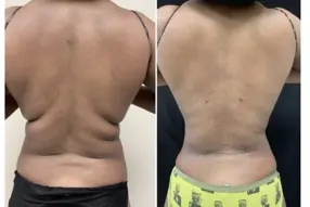 Before and after Back liposuction by Dr. Drew Varano in Washington DC