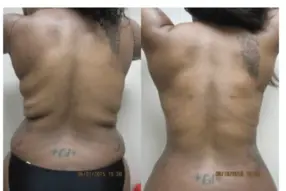 Before and after Back liposuction by Dr. Drew Varano in Washington DC