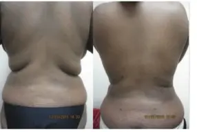 Before and after Back liposuction by Dr. Drew Varano in Washington DC