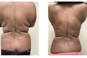 Before and after Back liposuction by Dr. Drew Varano in Washington DC