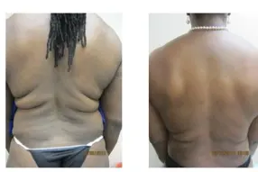 Before and after Back liposuction by Dr. Drew Varano in Washington DC