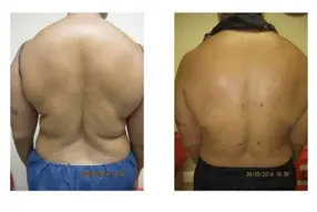 Before and after Back liposuction by Dr. Drew Varano in Washington DC
