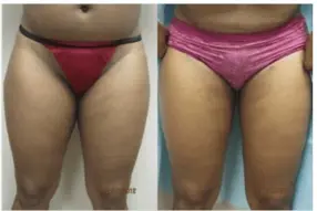 Before and after inner thigh liposuction by Dr. Drew Varano in Washington DC
