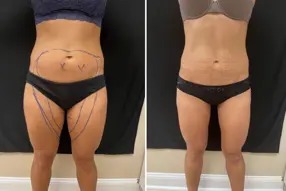 Before and after inner thigh and abds liposuction by Dr. Drew Varano in Washington DC