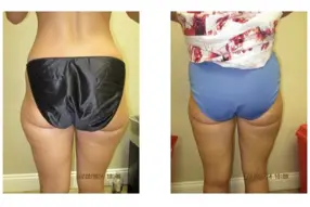 Before and after Thigh Liposuction treatment by Medical Cosmetic Enhancementsin Washington DC