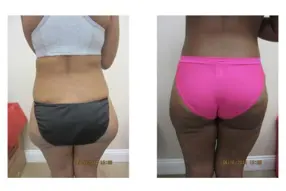 Before and after Liposuction Thigh treatment by Medical Cosmetic Enhancementsin Washington DC