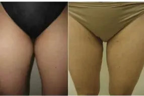 Before and after of thigh liposuction by Dr. Drew Varano in Washington DC