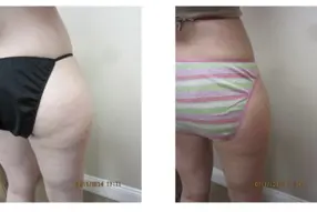 Liposuction outer thighs Results Washington DC-Dr. Drew Varano